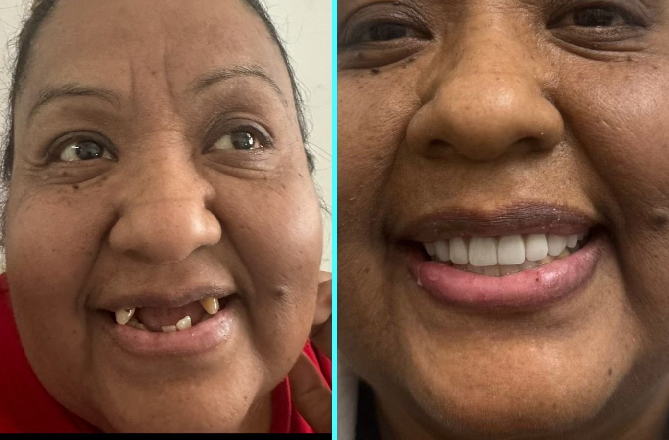 Why Choose Single Dental Implants in Mill Valley, CA by Center For Implant Dentistry A Center For Implant Dentistry expert carefully placing a single dental implant in Mill Valley, CA, demonstrating exceptional care and patient attention. Single Dental Implants near me.