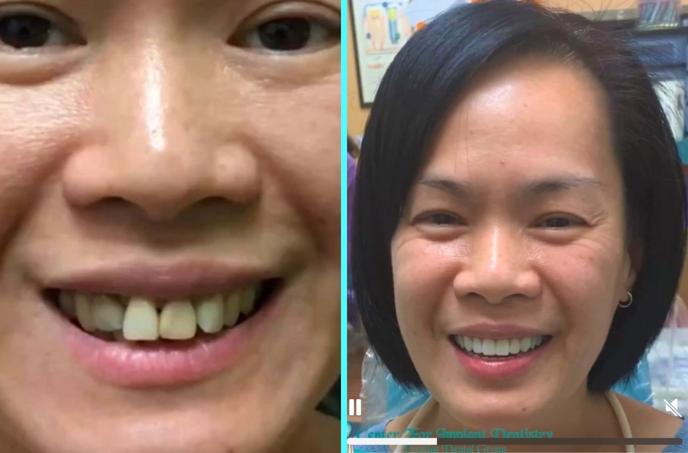 Why Choose Single Dental Implants in San Rafael, CA by Center For Implant Dentistry A Center For Implant Dentistry expert placing a single dental implant in San Rafael, CA, demonstrating our professional excellence and precision. Single Dental Implants near me.