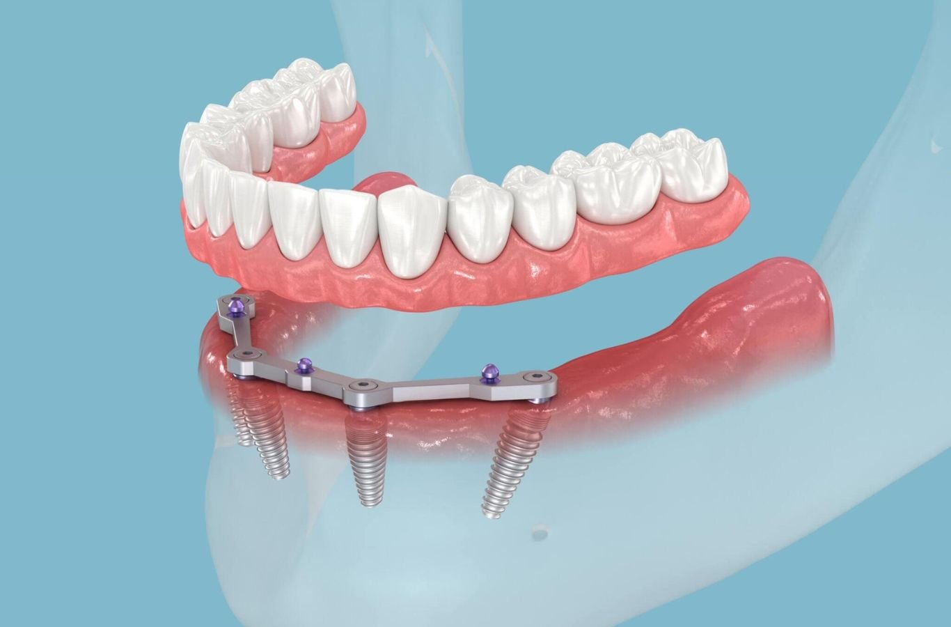 All-on-4 Dental Implants in Gilroy, CA by Center For Implant Dentistry A Center For Implant Dentistry professional placing All-on-4 Dental Implants in Gilroy, CA, demonstrating precision tools and clinical expertise.