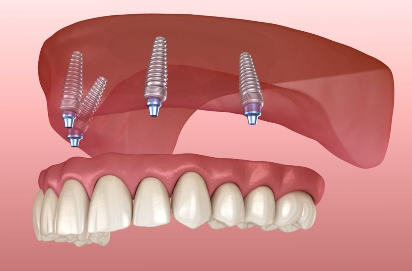All-on-4 Dental Implants in Oakland, CA by Center For Implant Dentistry A Center For Implant Dentistry employee delivering All-on-4 Dental Implants in Oakland, CA, using advanced tools to ensure comfort and high-quality outcomes.
