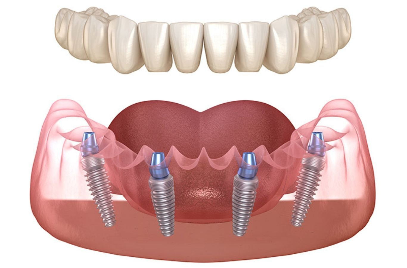 All-on-4 Dental Implants in Palo Alto, CA by Center For Implant Dentistry A Center For Implant Dentistry employee performing All-on-4 Dental Implants in Palo Alto, CA, applying expert techniques for outstanding dental outcomes.