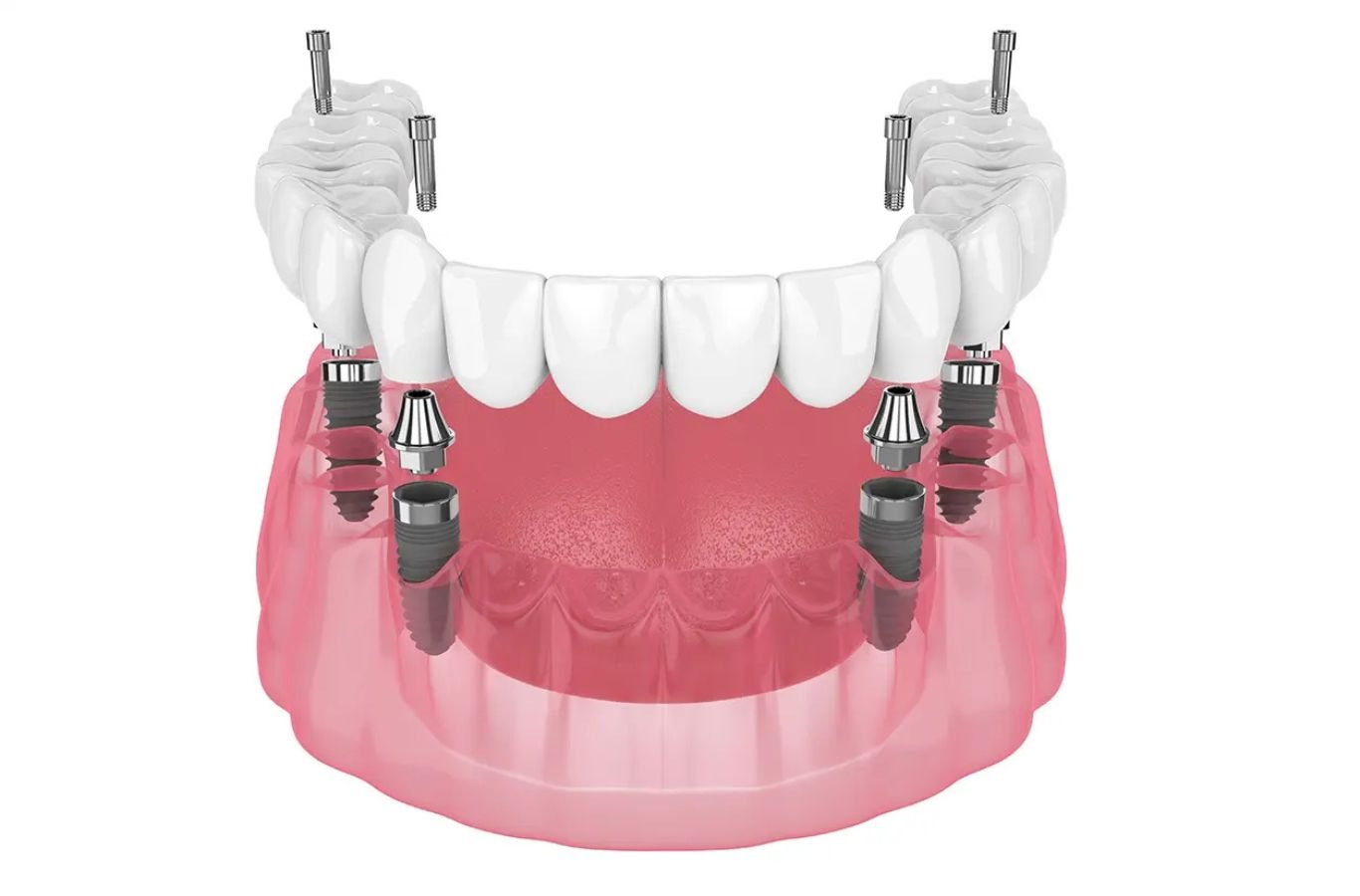 All-on-4 Dental Implants in Sunnyvale, CA by Center For Implant Dentistry A Center For Implant Dentistry specialist delivering All-on-4 Dental Implants in Sunnyvale, CA, using precision tools for high-quality care outcomes.