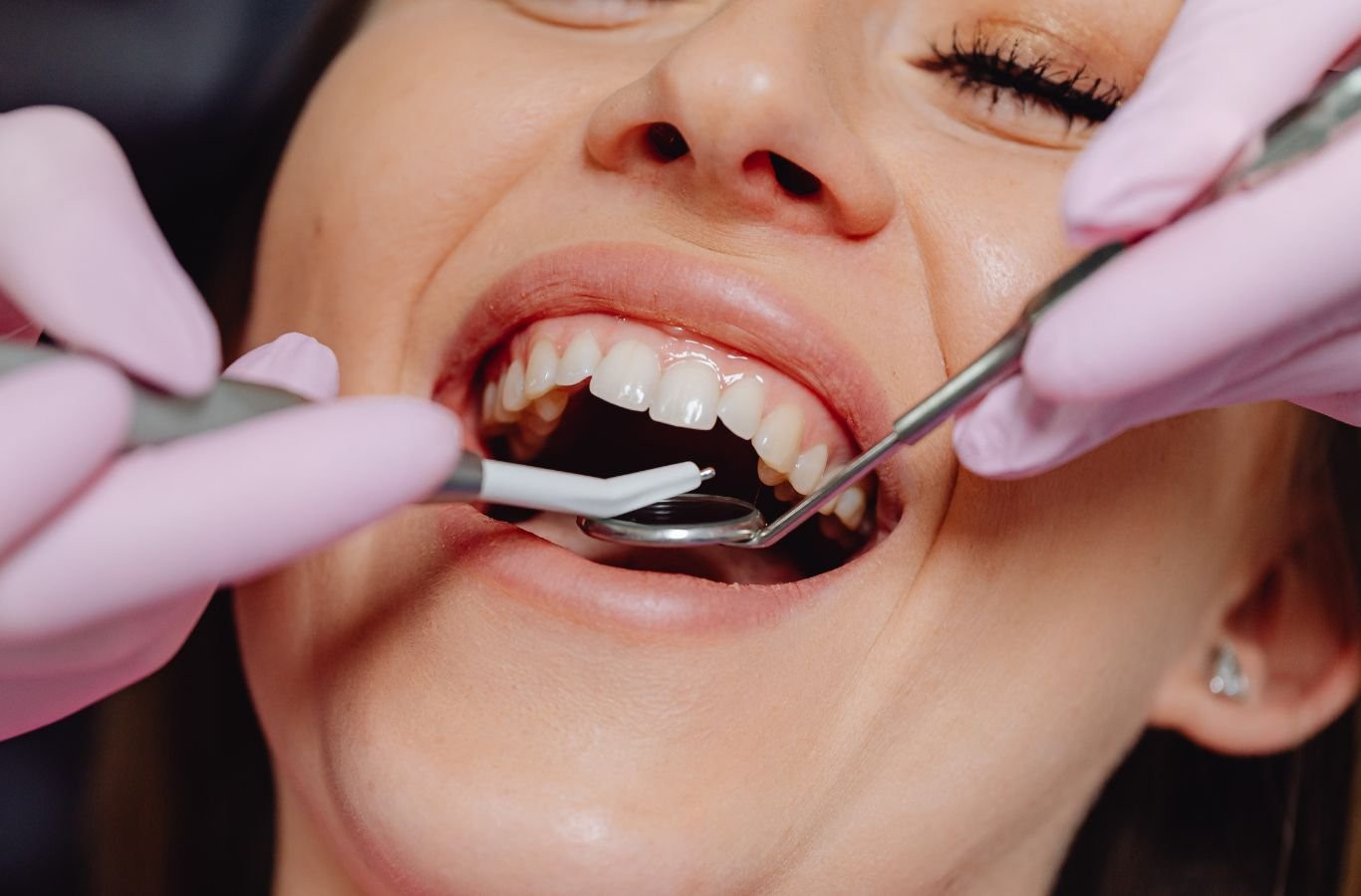 Dental Implant Complications in Gilroy, CA by Center For Implant Dentistry A Center For Implant Dentistry expert examining Dental Implant Complications in Gilroy, CA using advanced diagnostic tools and precision techniques.