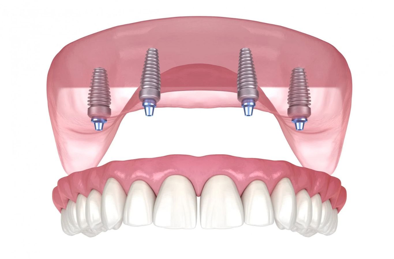 A Center For Implant Dentistry specialist performing All-on-4 dental implants in San Francisco with advanced tools and precise technique for lasting results.