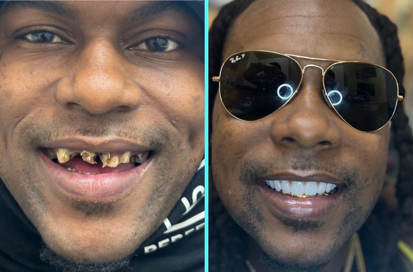 A Center For Implant Dentistry professional restoring a smile with All-on-4 dental implants in San Francisco, showing the advantages of local expert care.