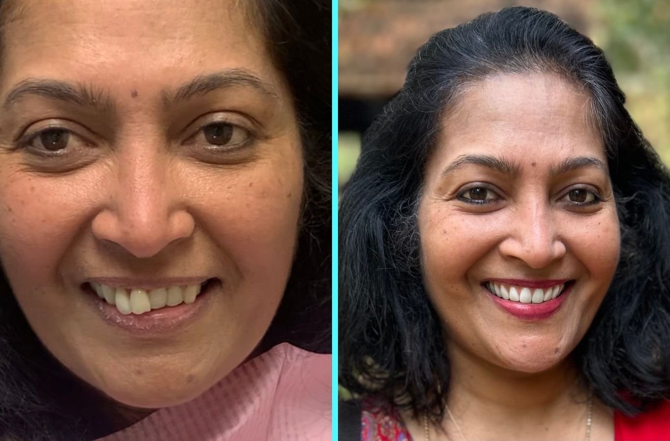 A Center For Implant Dentistry expert carefully placing All-on-4 dental implants in San Francisco, demonstrating trusted expertise and quality service. All-on-4 Dental Implants near me.