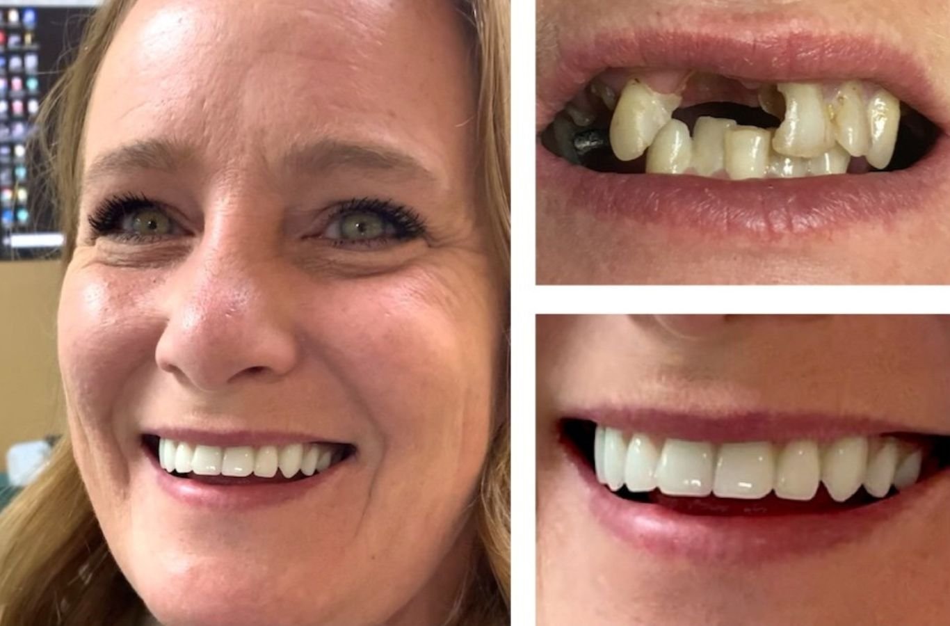 The expert team at Center For Implant Dentistry helping a Tracy, CA patient recover from dental implant complications with precise care and support.