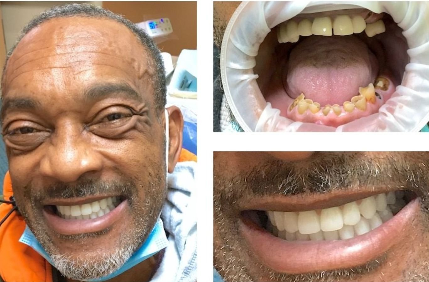 A dentist from Center For Implant Dentistry in Tracy, CA performing careful corrective implant surgery with professional expertise and attention. Dental Implant Complications near me.