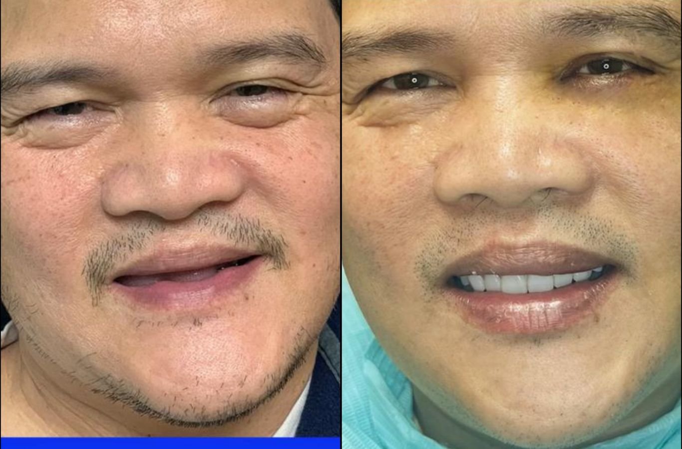 A dental professional from Center For Implant Dentistry in Watsonville, CA performing an implant correction with state-of-the-art technology and skill. Dental Implant Complications near me.